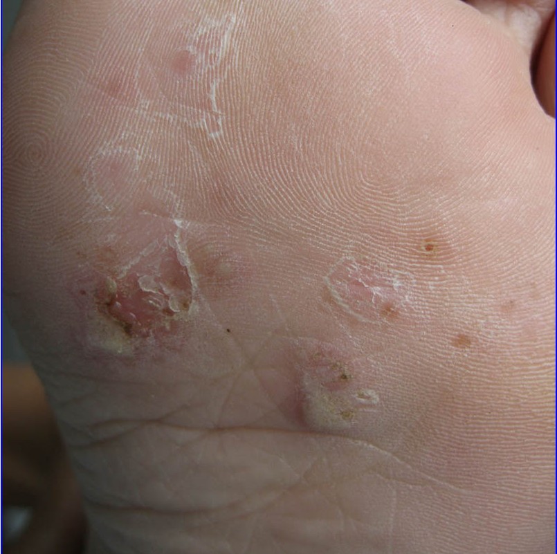 怎么去好的预防手足癣呢