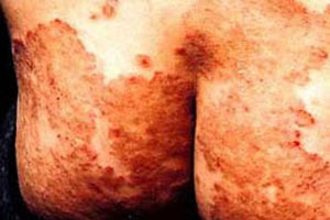 股癣的预防方法有哪些