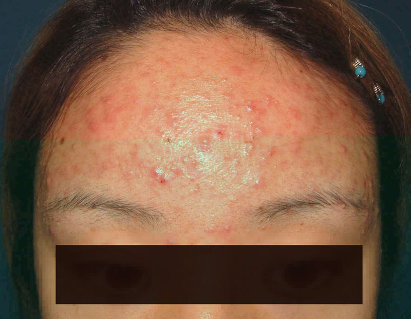 额头长小疙瘩症状图片