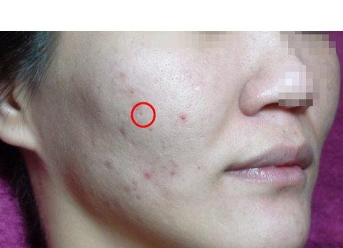 粉刺是什么样的