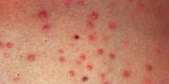 毛囊炎是怎么引起的