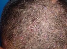 毛囊炎是什么症状