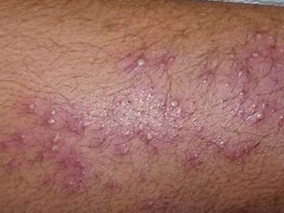 毛囊炎预防的方式是什么