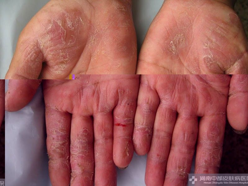 手足癣症状图片