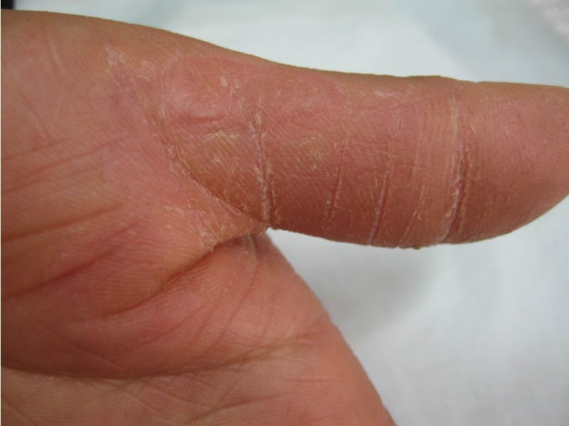 手上脱皮是怎么回事呢