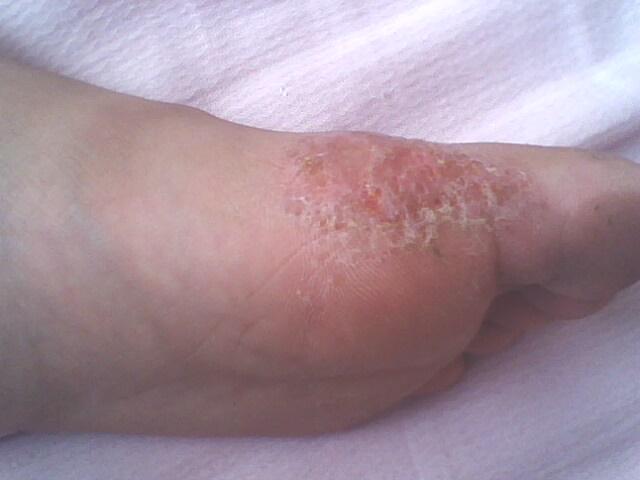 手足癣症状图片
