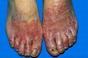 手足癣的临床表现是什么