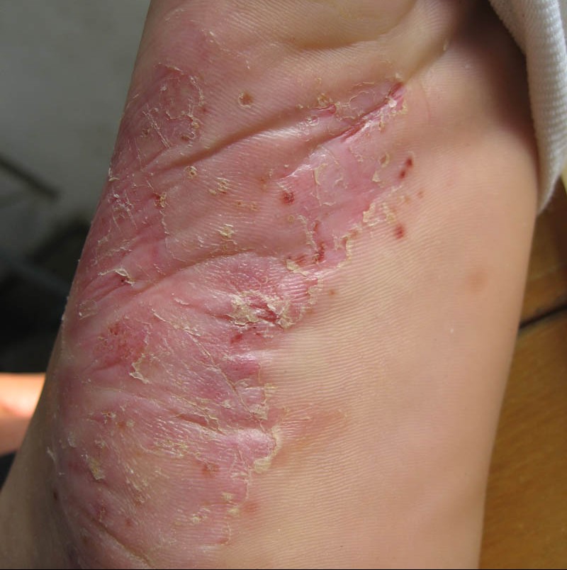 手足癣该如何预防呢