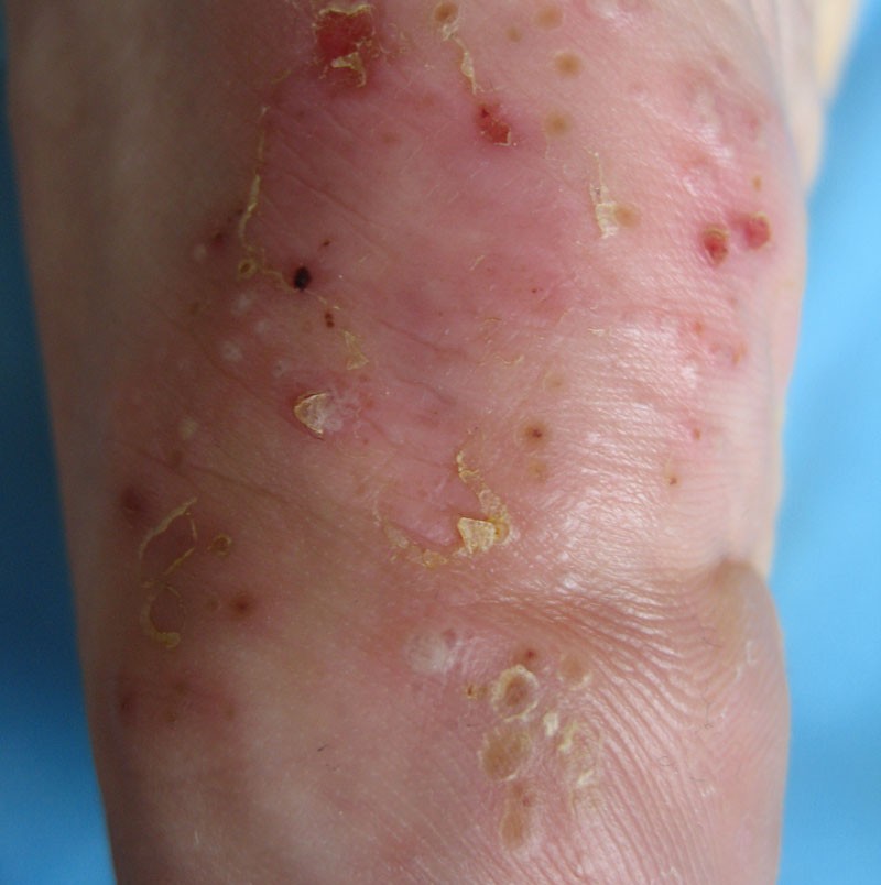 手足癣应该如何采取措施呢