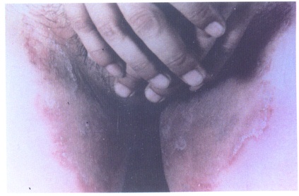 大腿肚内侧股癣图片