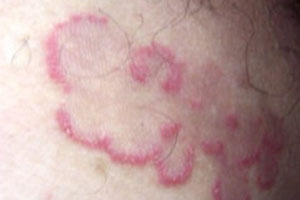 中年人股癣应该怎么进行预防