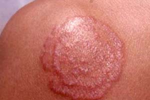 股癣应该从哪些方面来预防