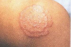 股癣患者应该怎么治疗和预防呢