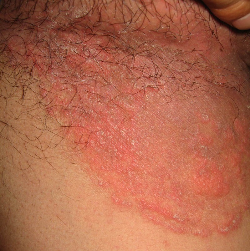 股癣该用什么药好