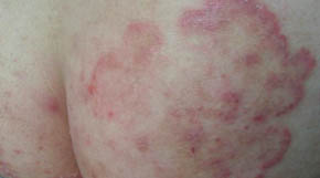 股癣用什么药好