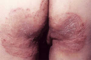 股癣与脚气的关系