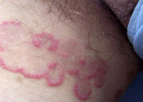 股癣主要的传播途径是什么