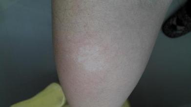 引起花斑癣的因素有哪些