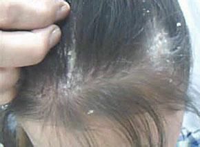 引发头癣的原因是什么