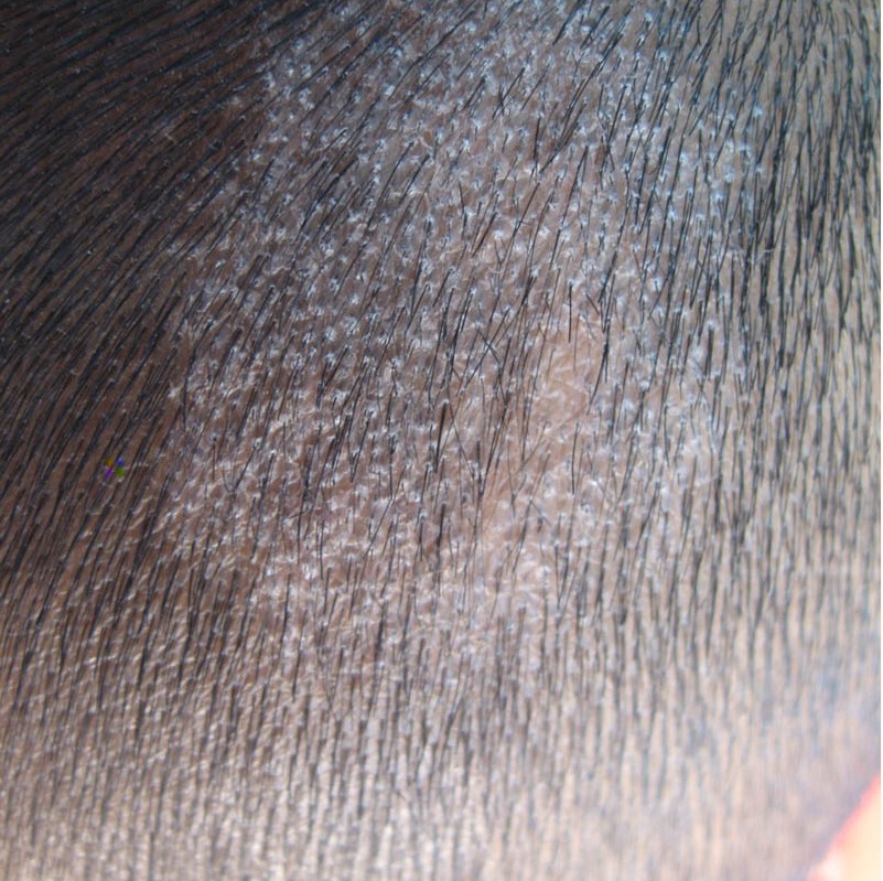 　头癣患者的注意事项有哪些? 